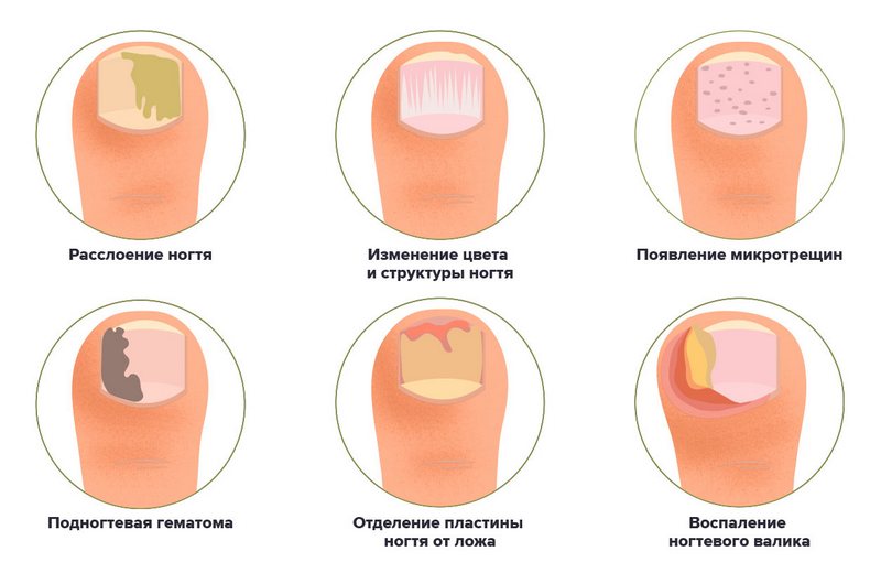 Микосептин Лак Для Ногтей